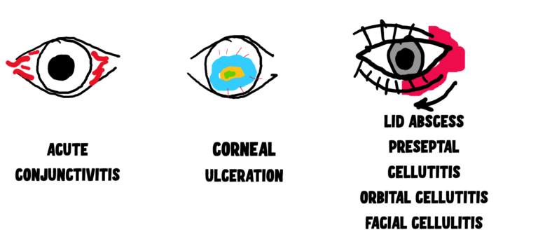 complications of acute dacryocystitis