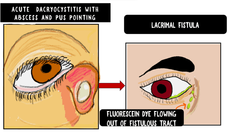 Stages of acute dacryocystitis