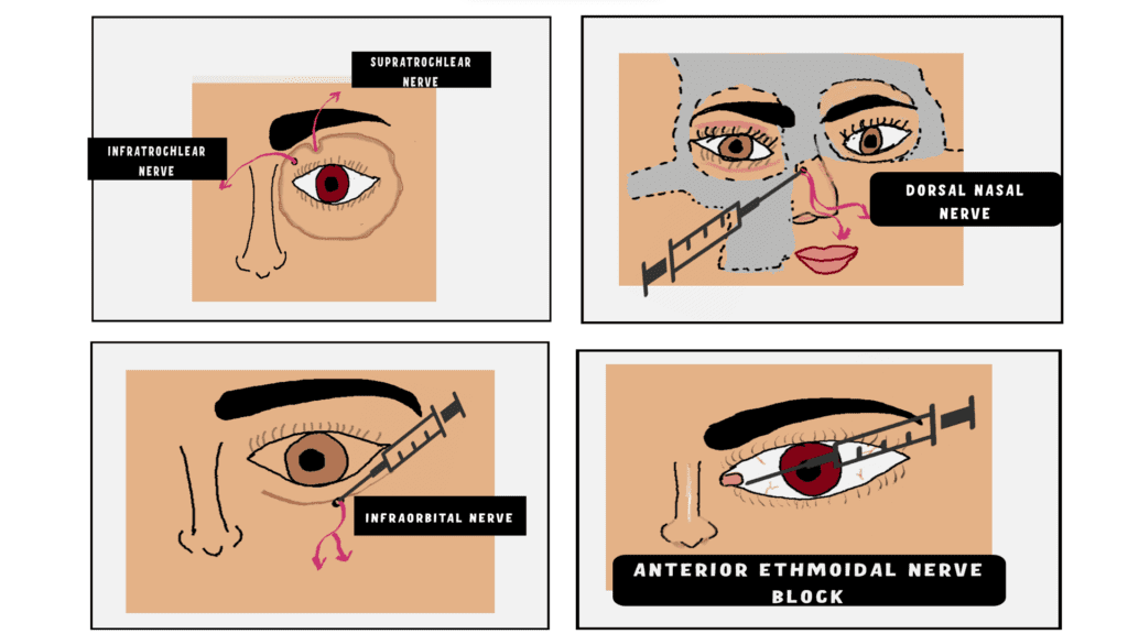 Nerve Blocks for lacrimal sac surgeries
