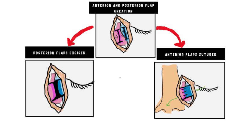 Flaps creation in Dacryocystorhinostomy