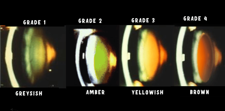 image depicting rough estimation of hardness of lens based on the color of the lens