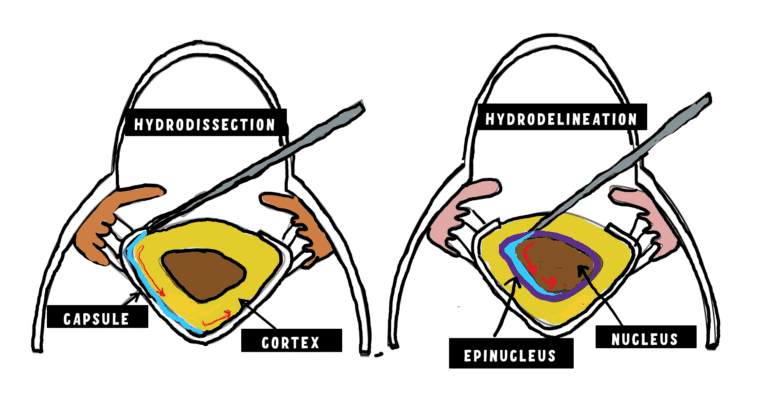 image illustrating hydrodissection and hydrodelineation