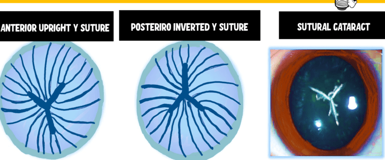 image depicting the two types of sutures of the lens. Upright Y suture and Inverted Y suture . It also depicts a sutural cataract