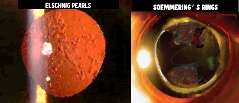 image illustrating the two types of posterior capsular opacifications( PCO); elschnig pearls and sommerings rings