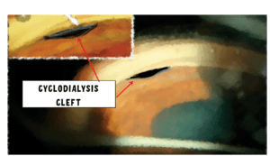 image showing Cyclodialysis cleft