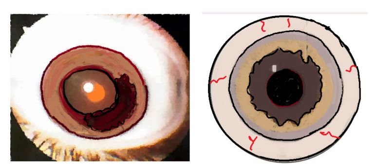 image depicting ectropion uvea