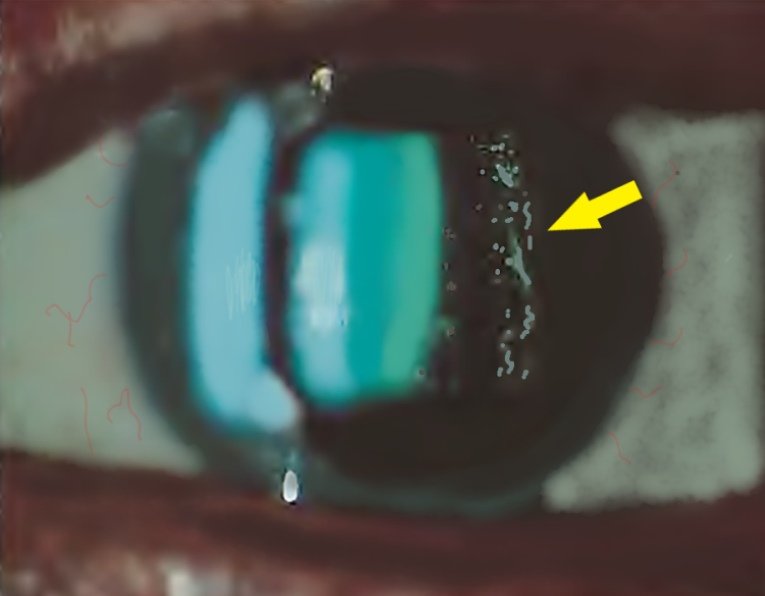 image showing vitreous cells in intermediate Uveitis