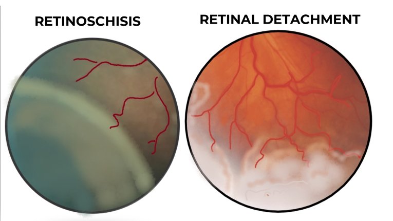 Retinal detachment and retinoschisis as a complication of the intermediate uveitis