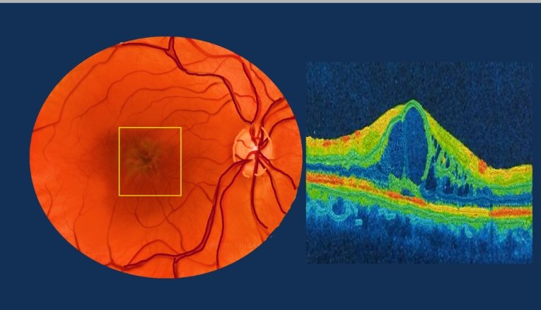 fundus photograph of cystoid macular edema. The oct showing CME