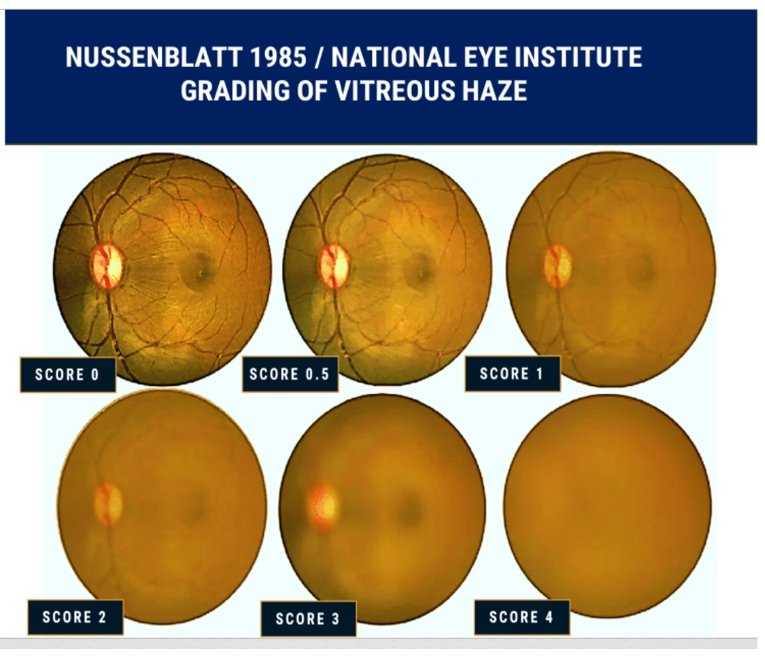 nussenblat classification of vitreous haze