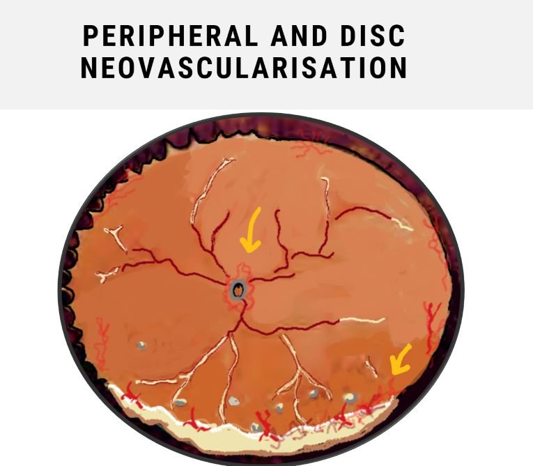 image showing neovascularisation as a complication in intermediate uveitis