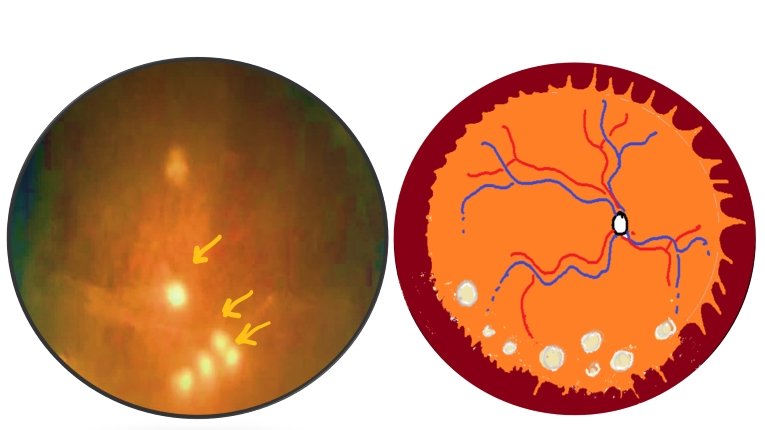image showing vitreous snowballs in intermediate uveitis