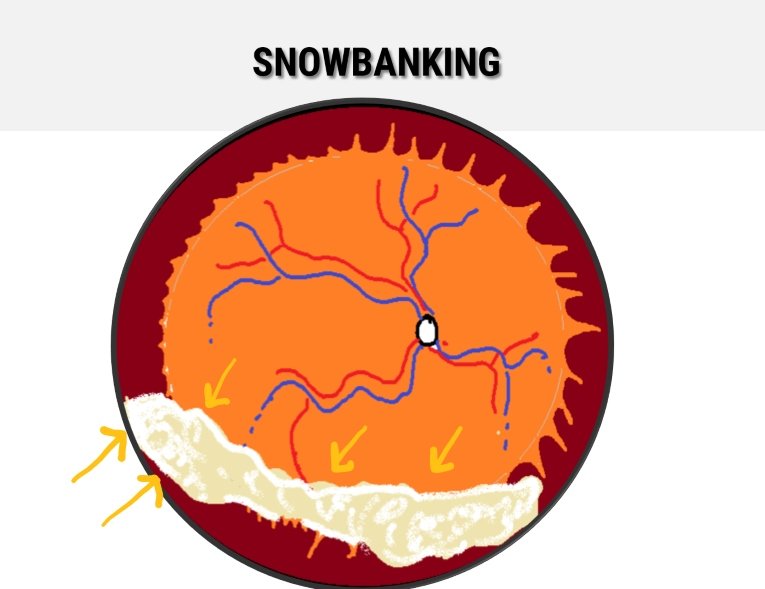 snowbanking in intermediate uveitis