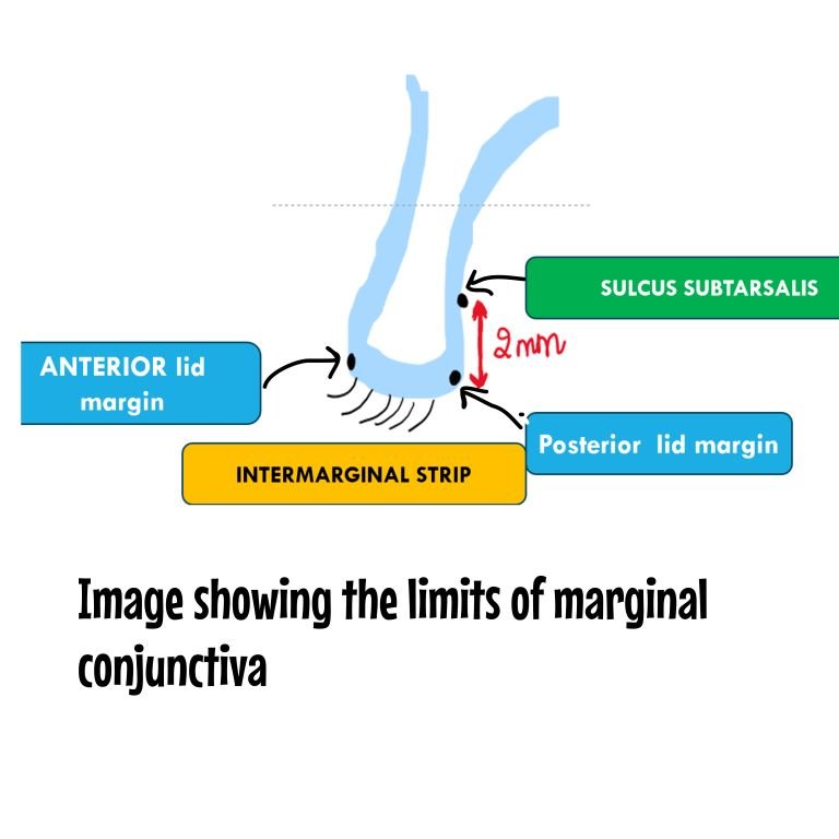 Image depicting the limits of marginal conjunctiva