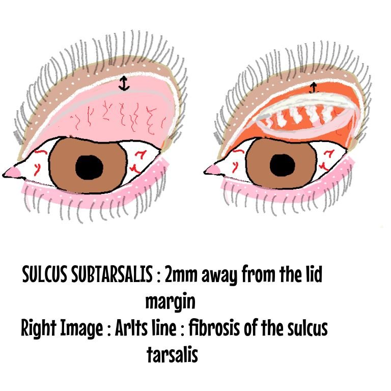 Diagram of sulcus subtarsalis and arlts line