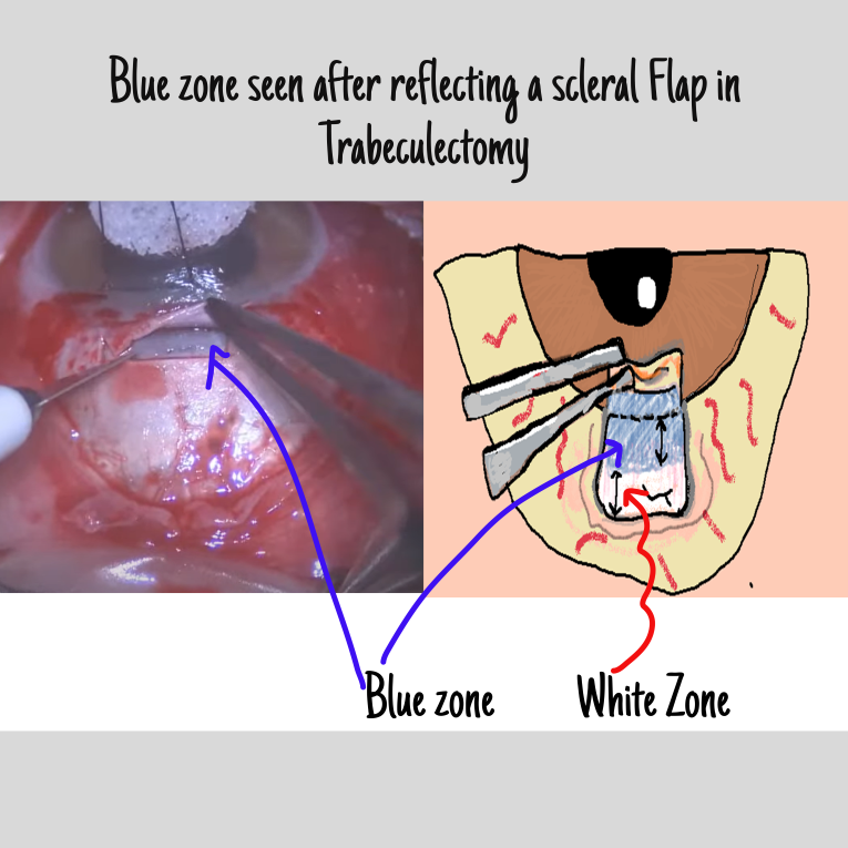 blue zone of limbus seen after raising a scleral flap in trabeculectomy
