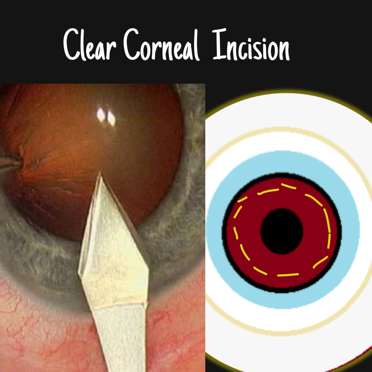 clear corneal incision
