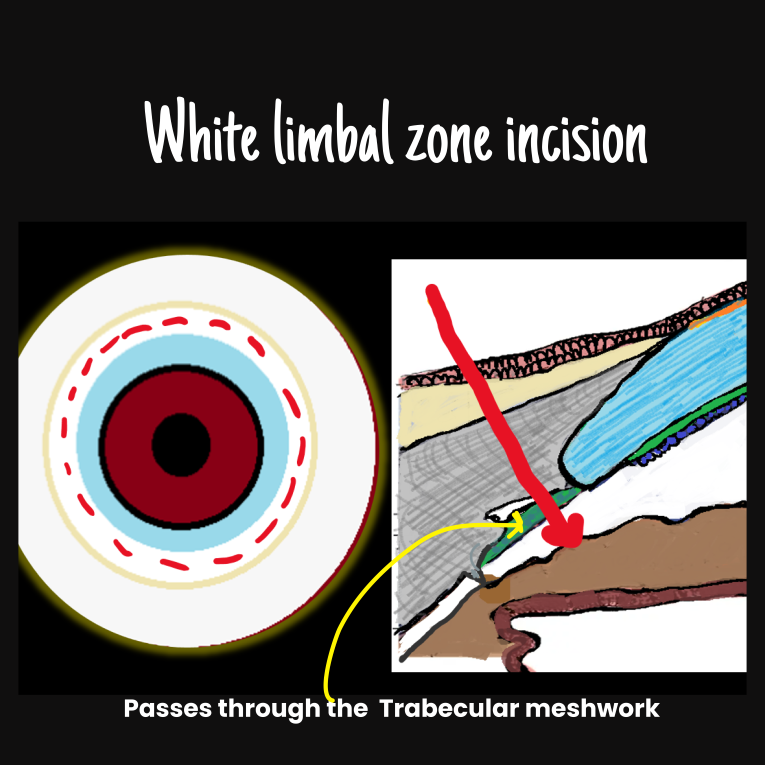 white-zone-limbal-incision