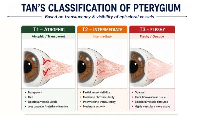 Diagram showing Tan classification of pterygium based on translucency and visibility of episcleral vessels