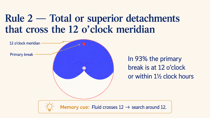 Lincoff Rule 2 showing a superior or total retinal detachment crossing the 12-o'clock meridian.