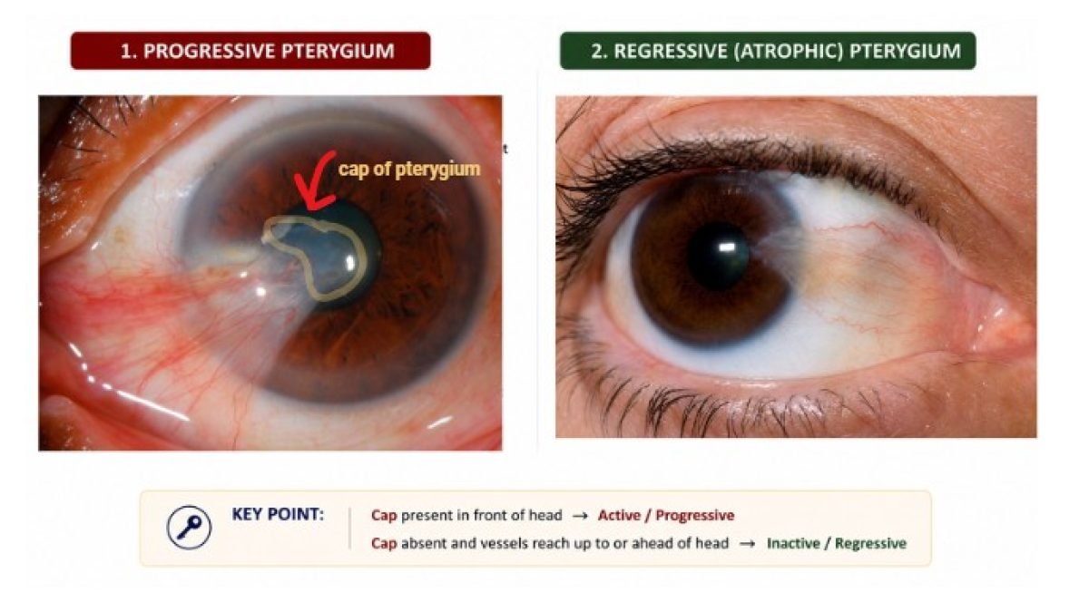 clinical images showing progressive vs regressive pterygium